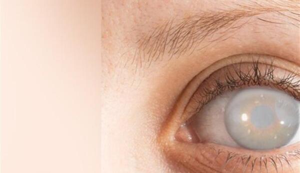عکس چشم بعد از عمل آب مروارید