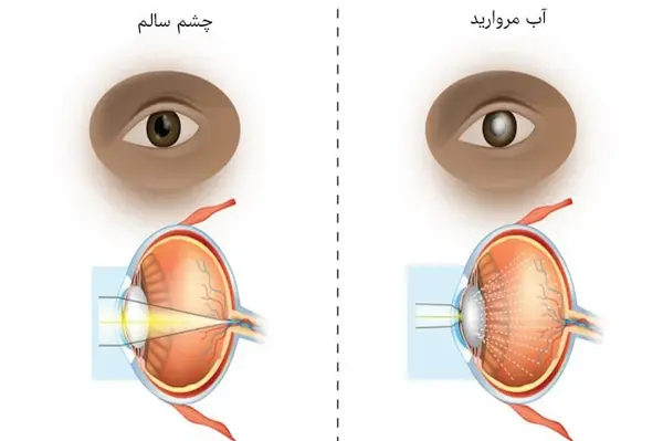 عکس چشم بعد از عمل آب مروارید