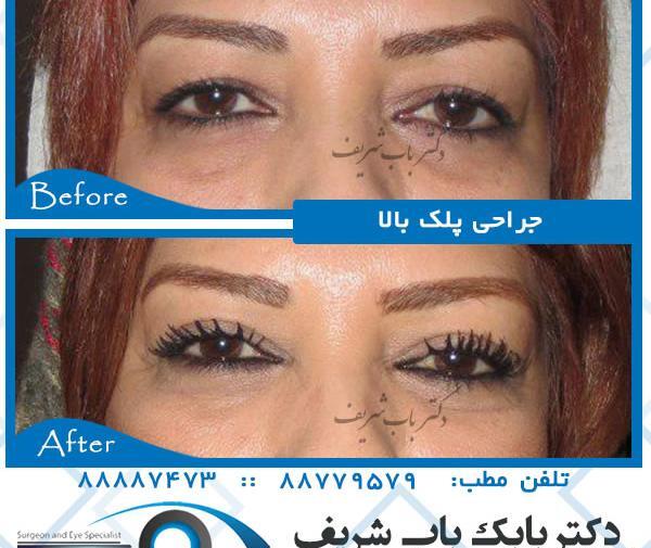 عکس های عمل لیزیک چشم