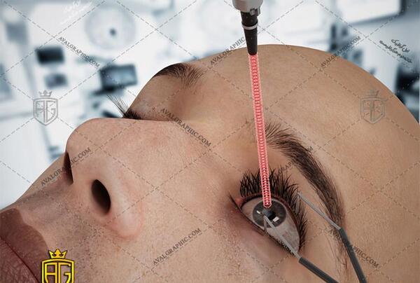 عکس های عمل لیزیک چشم