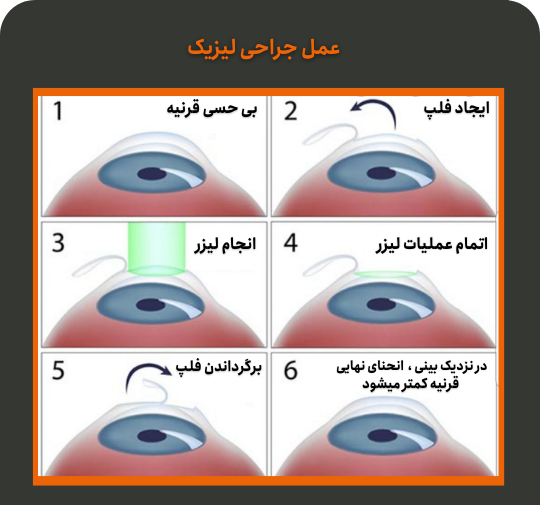 عکس های عمل لیزیک چشم