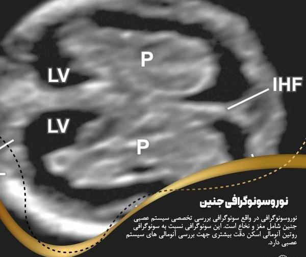 عکس چشم جنین در سونوگرافی