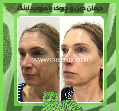 عکس صورت بعد از مزونیدلینگ