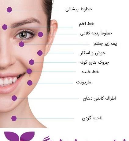 عکس صورت بعد از مزونیدلینگ