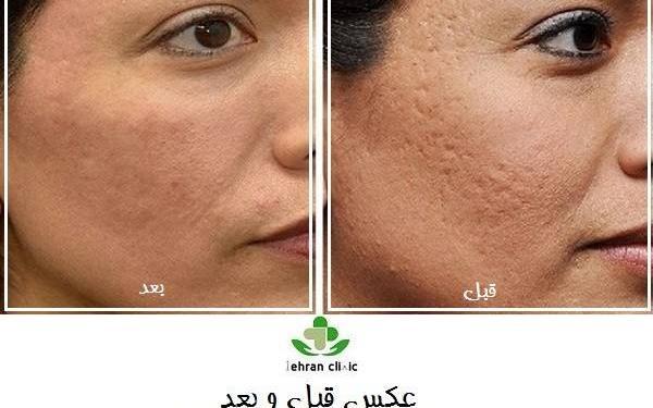 عکس صورت بعد از مزونیدلینگ