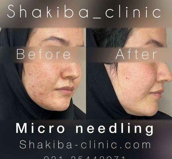 عکس صورت بعد از مزونیدلینگ