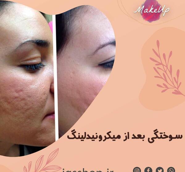 عکس صورت بعد از مزونیدلینگ