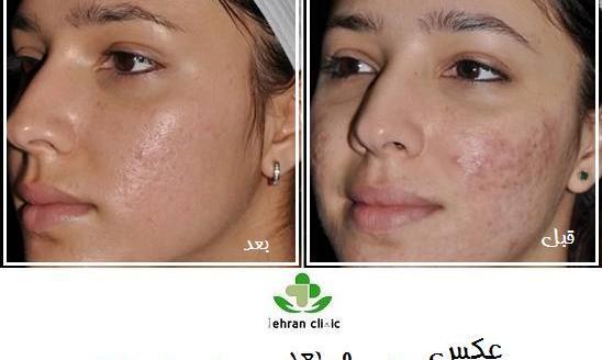 عکس صورت بعد از مزونیدلینگ