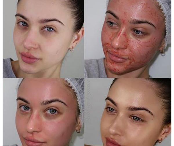 عکس صورت بعد از مزونیدلینگ