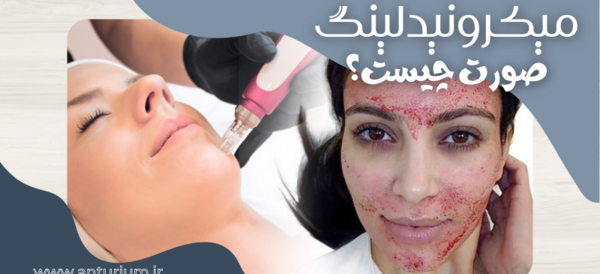 عکس صورت بعد از مزونیدلینگ