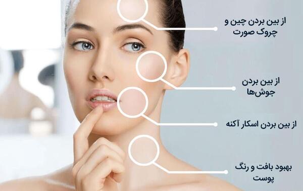 عکس صورت بعد از مزونیدلینگ