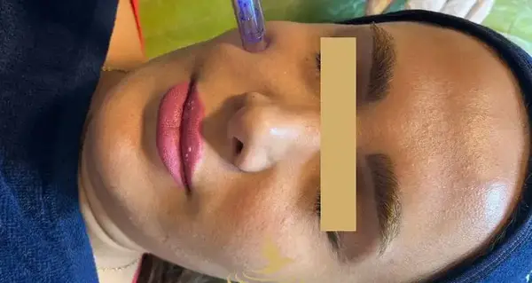 عکس صورت بعد از مزونیدلینگ
