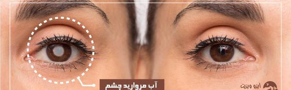 عکس بیماری آب مروارید چشم