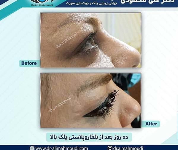عکس عمل چشم لیزیک