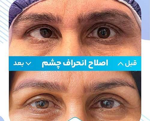 عکس عمل چشم لیزیک