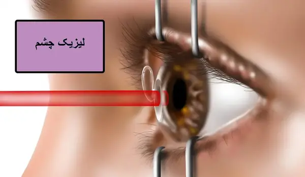 عکس عمل چشم لیزیک
