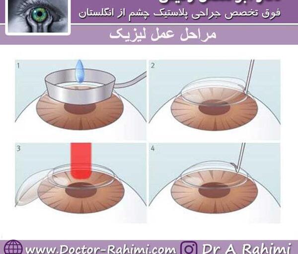عکس عمل چشم لیزیک