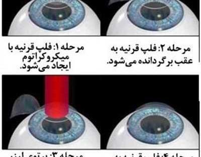 عکس عمل چشم لیزیک