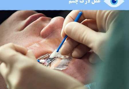 عکس عمل چشم لیزیک