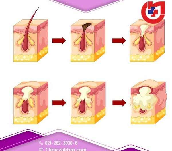 عکس جوش ناحیه تناسلی زنان درمان خانگی
