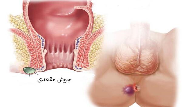 عکس جوش ناحیه تناسلی زنان درمان خانگی