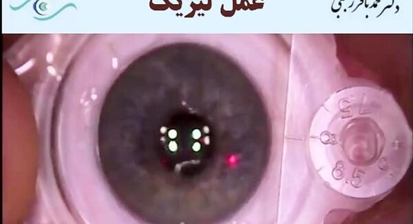 عکس دستگاه لیزیک چشم