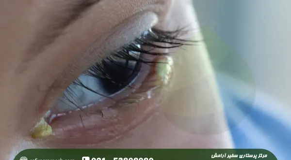عکس بچه های چشم زاغ