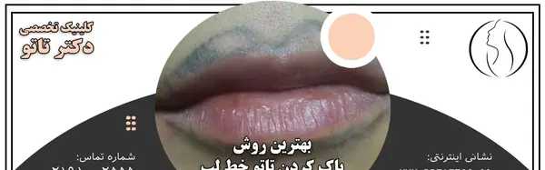 عکس تاتو لب قبل و بعد