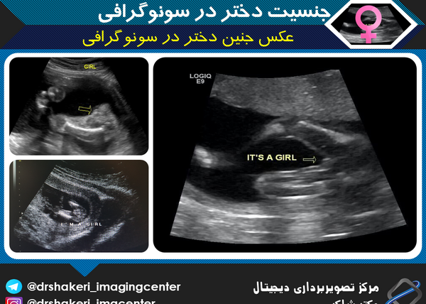 عکس جنین دختر در سونوگرافی آنومالی