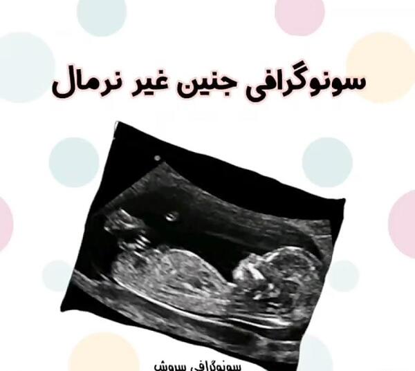 عکس جنین دختر در سونوگرافی آنومالی