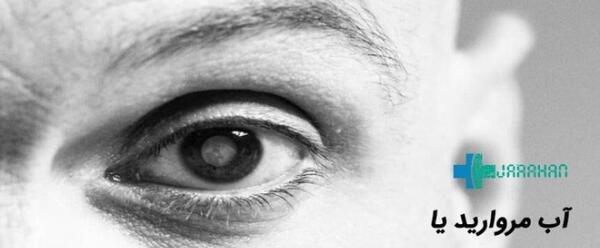 عکس های آب مروارید چشم