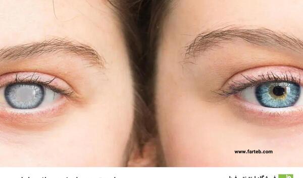 عکس های آب مروارید چشم