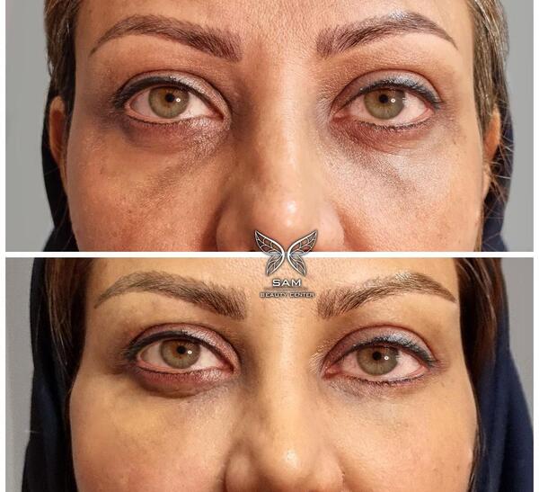 عکس چشم زخمی شده