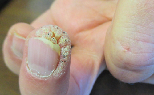 عکس تصاویر بیماری گال در ناحیه تناسلی مردان