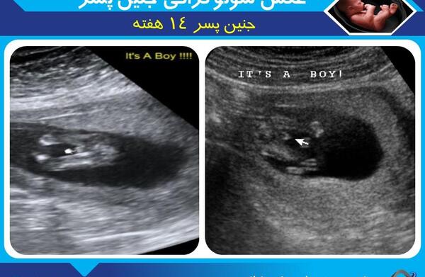 عکس جنین ۱۰ هفته پسر