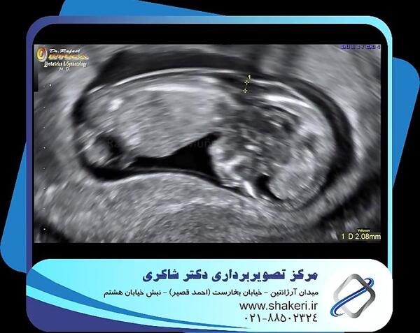 عکس سونوگرافی جنین پسر در دوازده هفته