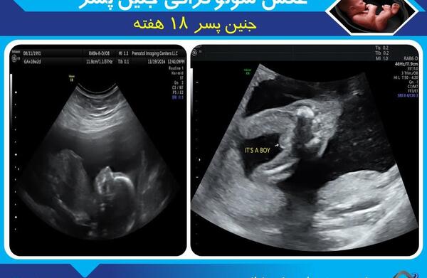 عکس سونوگرافی جنین دختر در ۱۸هفتگی