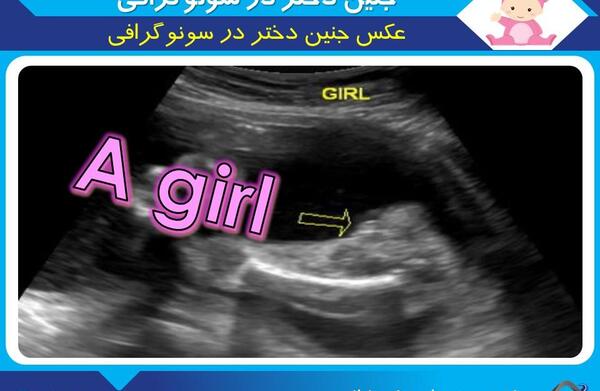 عکس سونوگرافی جنین دختر در ۱۸هفتگی
