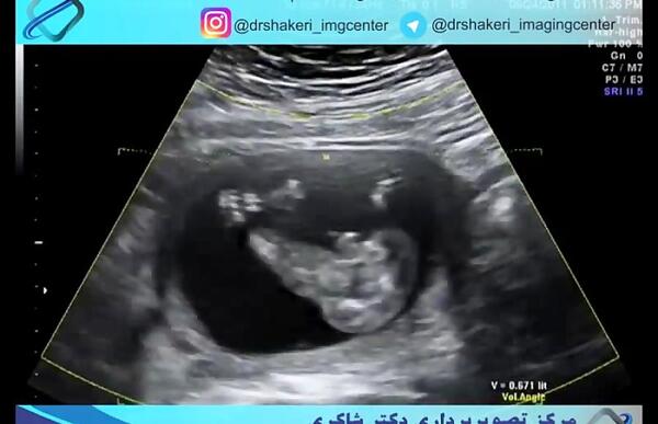 عکس سونو جنین پسر دوازده هفته