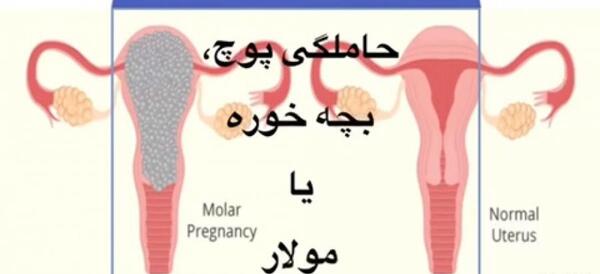 زایمان عکس بچه خوره در رحم
