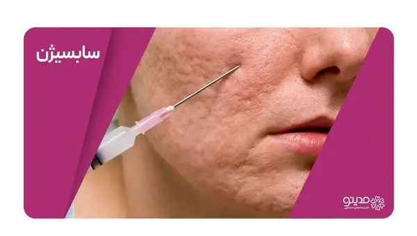 عکس صورت بعد از سابسیژن