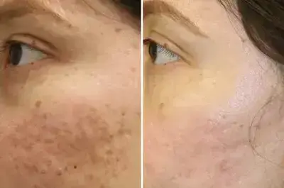 عکس صورت بعد از سابسیژن