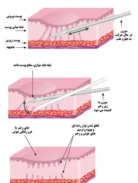 عکس صورت بعد از سابسیژن