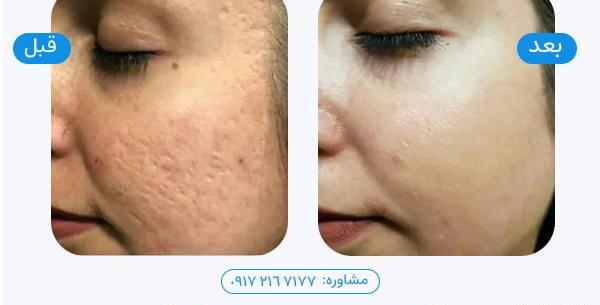 عکس صورت بعد از سابسیژن