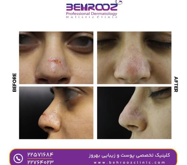 عکس صورت بعد از سابسیژن