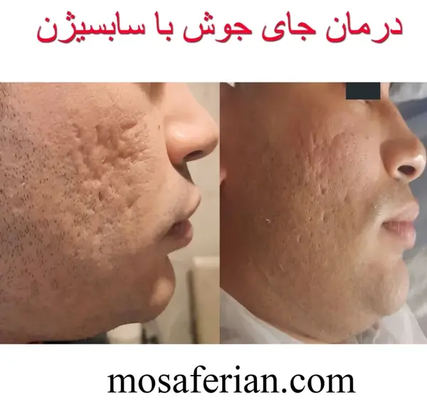 عکس صورت بعد از سابسیژن