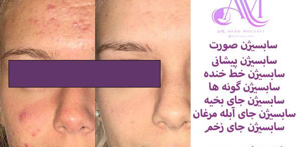 عکس صورت بعد از سابسیژن