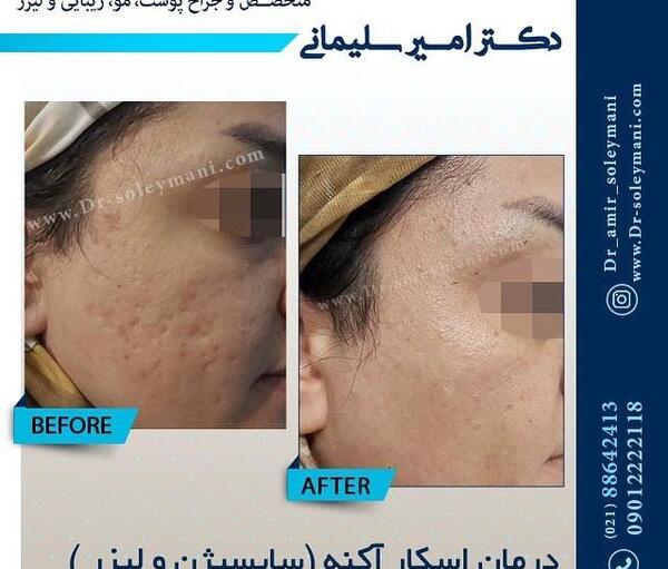 عکس صورت بعد از سابسیژن