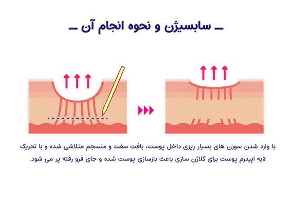 عکس صورت بعد از سابسیژن