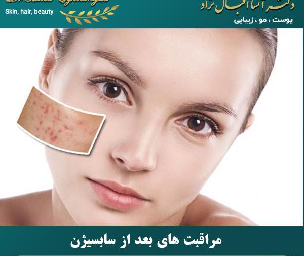 عکس صورت بعد از سابسیژن